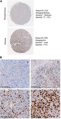High Expression of PLAGL2 is Associated With Poor Prognosis in High-Grade Glioma